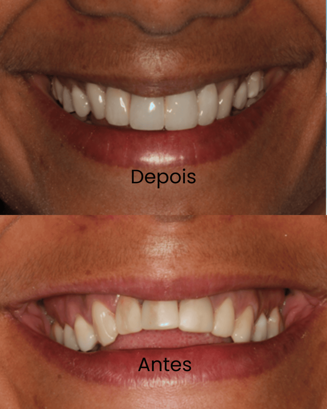 Antes-_1_