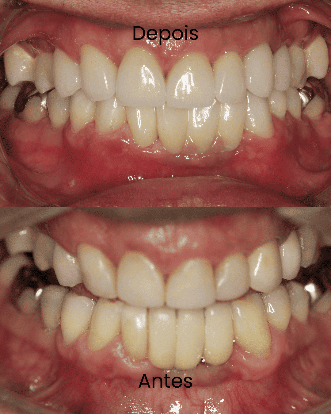 Antes-_3_