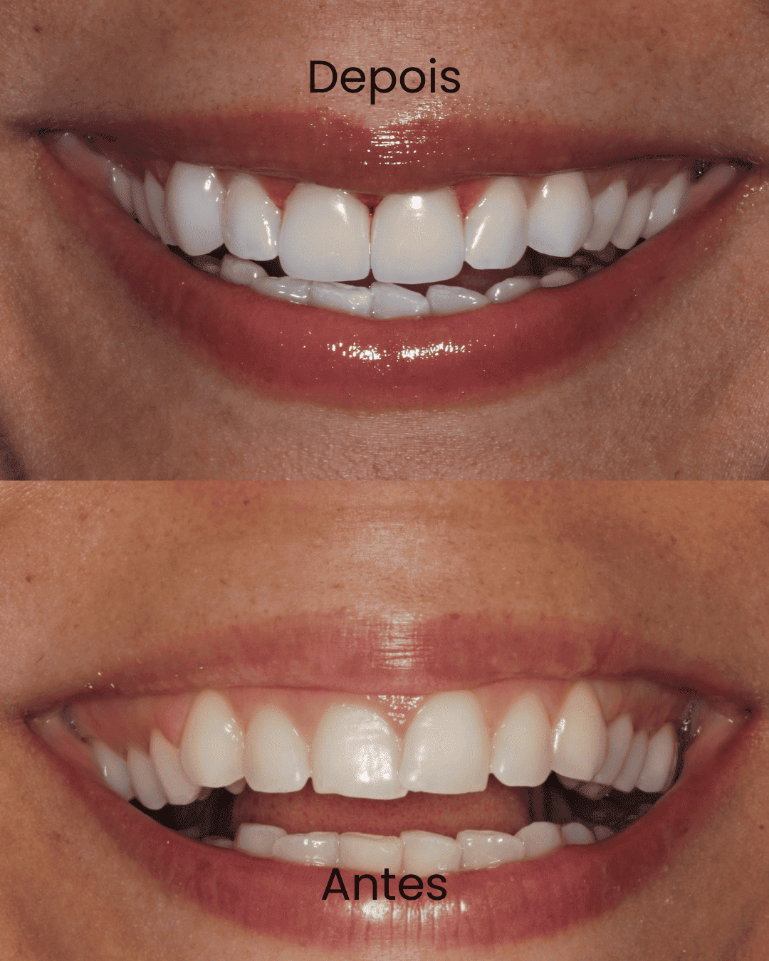Antes-_4_